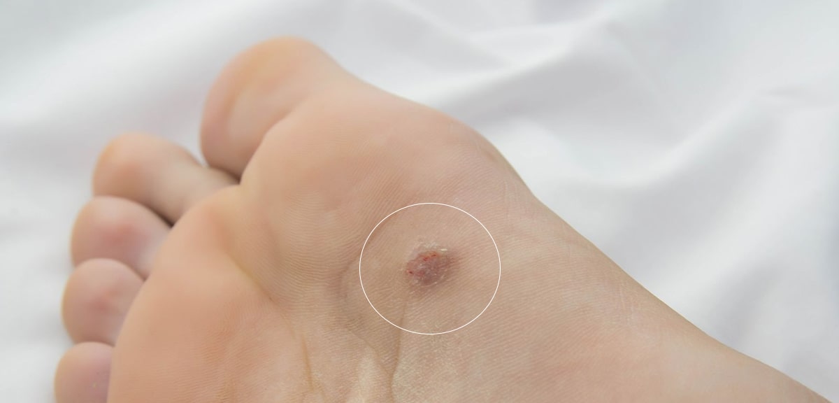 Papiloma plantar
