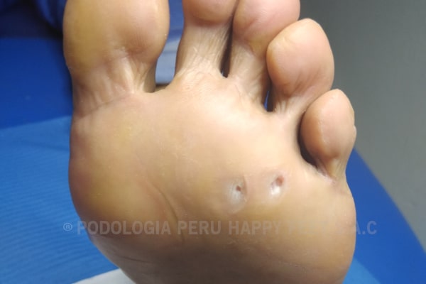 podologia cerca surco