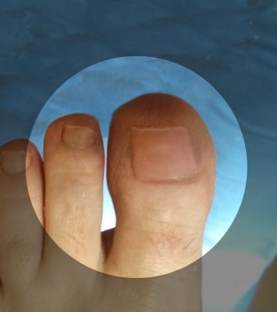 uñas atrofiadas, uñas con hongos, recosntrruccion de uñas con gel de clotrimazol medicado - podologia peru