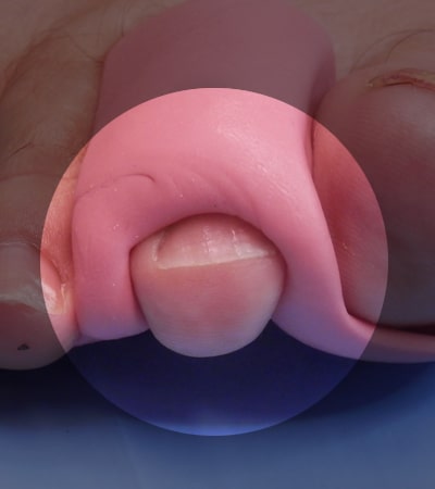 ORTESIS de silicona solución uñas en garra, otros, helomas o callos - podologia peru
